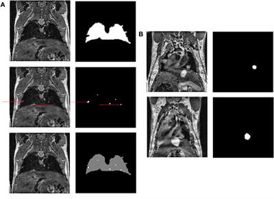 Deep learning model for automatic segmentation of lungs and pulmonary metastasis in small animal MR images